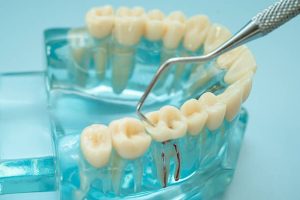 New Dental Implant