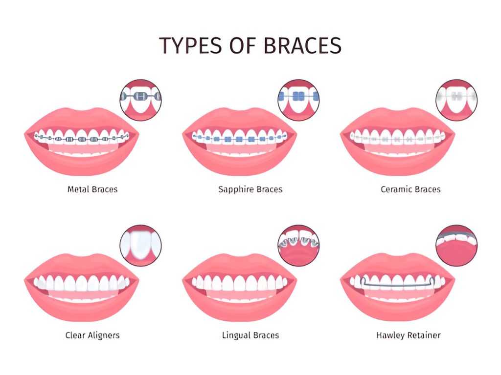 Your Guide to Different Types of Braces