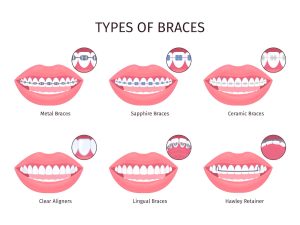 Your Guide to Different Types of Braces